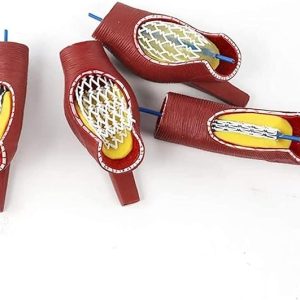 Coronary Stent